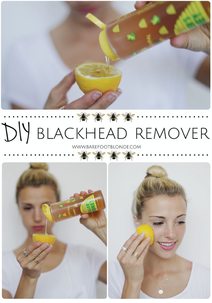 DIY Blackhead Remover