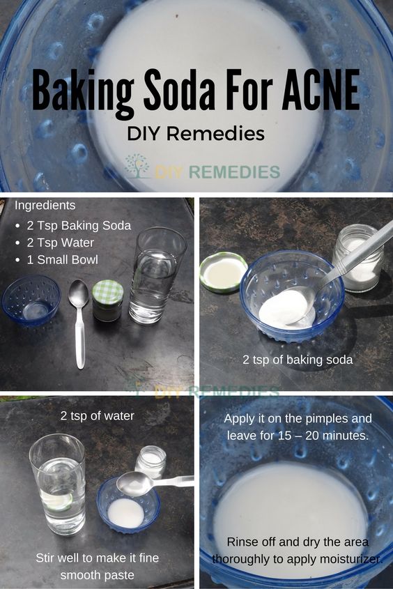 7 Ways to Remove Blackheads At Home