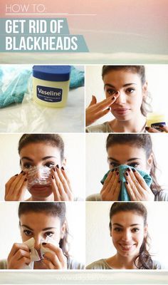 Get Rid of Blackheads