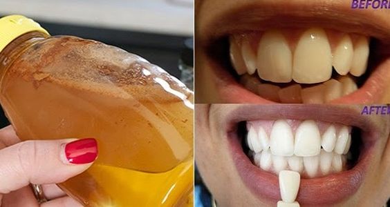 7 Ways to Whiten Your Teeth At Home