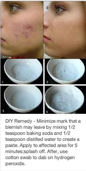 How to Eliminate Acne Scars