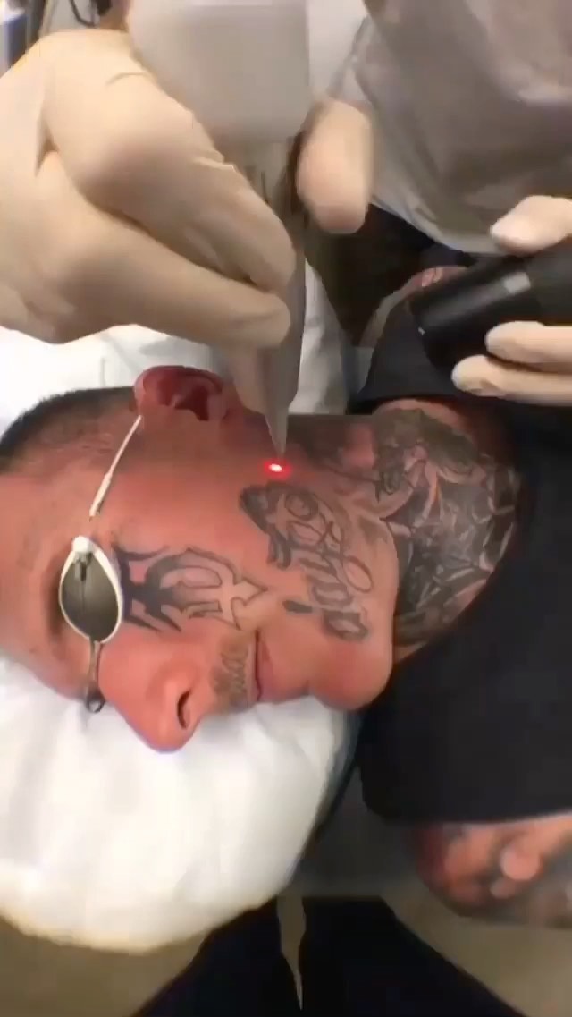 Tattoo Removal 101